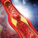 Hipertensión, colesterol, tabaco y obesidad: placa coronaria más quebradiza y mayor riesgo de infarto