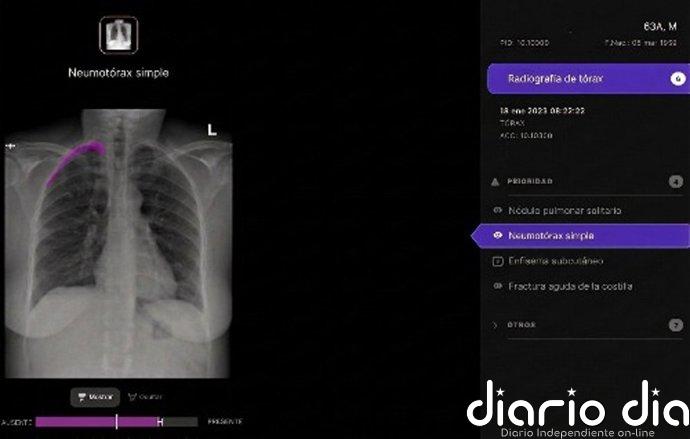 Telefónica y la sanitaria Harrison.ai se alían para apoyar el diagnóstico en radiografías de tórax con IA