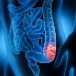 Una terapia ya aprobada contra otro cáncer podría mejorar el tratamiento del cáncer colorrectal avanzado