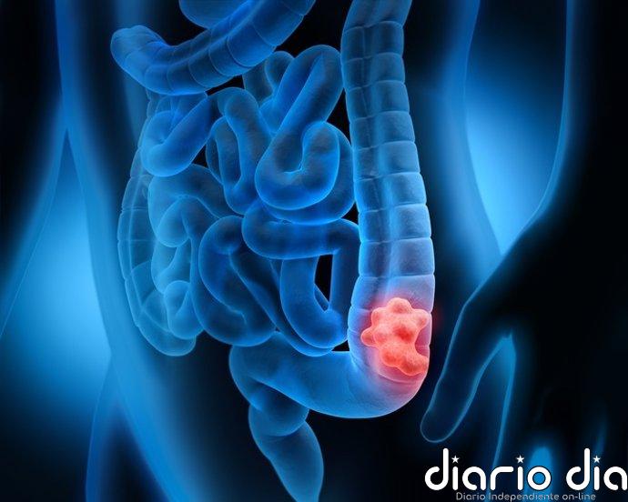 Una terapia ya aprobada contra otro cáncer podría mejorar el tratamiento del cáncer colorrectal avanzado