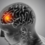 Hallán alteraciones tempranas del lenguaje narrativo en pacientes con Parkinson