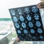 La epilepsia infantil se asocia con un menor nivel educativo a largo plazo