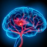 Reducir intensivamente la presión arterial disminuye un 38% el riesgo de sufrir otro ictus tras una hemorragia cerebral