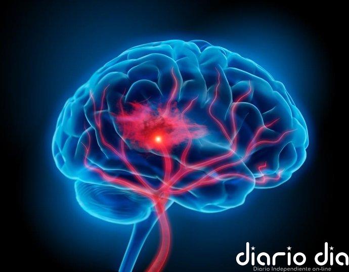 Reducir intensivamente la presión arterial disminuye un 38% el riesgo de sufrir otro ictus tras una hemorragia cerebral