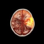 Siemens Healthineers recibe 26,5 millones de euros de ARPA-H para impulsar la robótica endovascular autónoma
