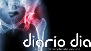 ¿Tienes artrosis de cadera El ejercicio que más recomiendan los traumatólogos (y el que conviene evitar)
