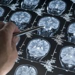 Un nuevo estudio busca detectar el Alzheimer hasta 20 años antes de los primeros síntomas