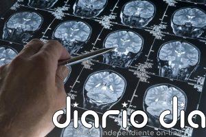 Un nuevo estudio busca detectar el Alzheimer hasta 20 años antes de los primeros síntomas