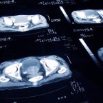 Cáncer de próstata: cambiar grasas animales por aceite de oliva y frutos secos se asocia a menor mortalidad
