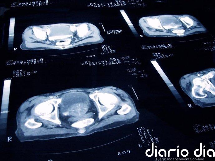 Cáncer de próstata: cambiar grasas animales por aceite de oliva y frutos secos se asocia a menor mortalidad
