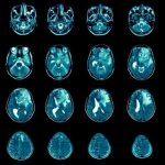 Glioma: descubren que la biología de este agresivo cáncer cerebral cambia alrededor de los 26 años
