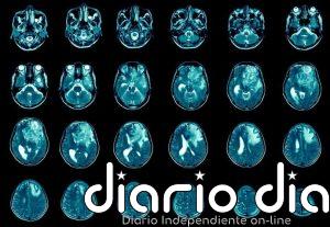 Glioma: descubren que la biología de este agresivo cáncer cerebral cambia alrededor de los 26 años