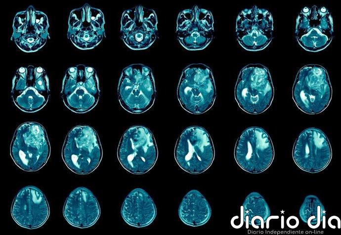Glioma: descubren que la biología de este agresivo cáncer cerebral cambia alrededor de los 26 años