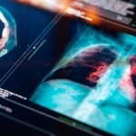 Identifican una vía para frenar la fibrosis pulmonar