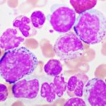 Leucemia mieloide aguda: un tratamiento menos intensivo duplica el tiempo hasta el fracaso frente a la quimioterapia