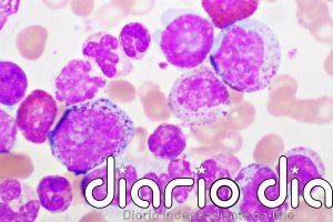 Leucemia mieloide aguda: un tratamiento menos intensivo duplica el tiempo hasta el fracaso frente a la quimioterapia