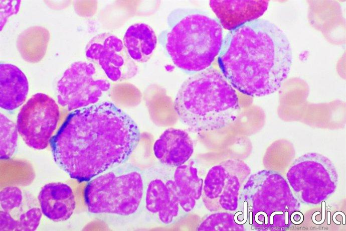 Leucemia mieloide aguda: un tratamiento menos intensivo duplica el tiempo hasta el fracaso frente a la quimioterapia