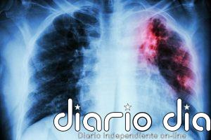 Neumólogos destacan los avances en diagnóstico y tratamiento de la fibrosis quística y piden seguir investigando