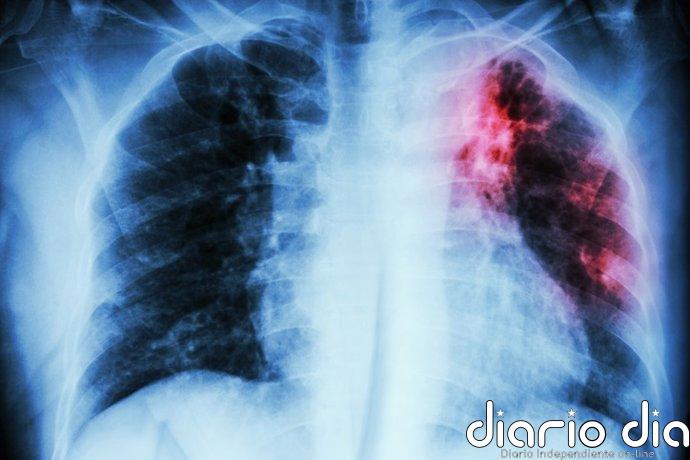 Neumólogos destacan los avances en diagnóstico y tratamiento de la fibrosis quística y piden seguir investigando