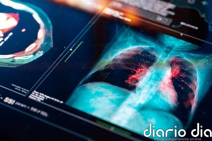 ¿Pueden los microplásticos contribuir al cáncer de pulmón? Un estudio encuentra estas párticulas en pacientes