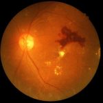 Un medicamento oral podría proteger la visión frente a la retinopatía diabética