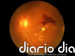 Un medicamento oral podría proteger la visión frente a la retinopatía diabética