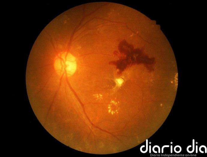 Un medicamento oral podría proteger la visión frente a la retinopatía diabética