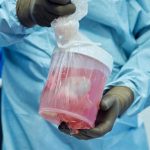 Un riñón de cerdo modificado genéticamente mantiene 271 días sin diálisis hasta recibir un trasplante humano