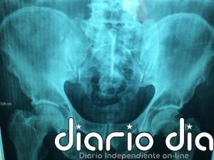 Una IA puede predecir quién sufrirá una fractura de cadera y detectar hasta siete veces más personas en riesgo