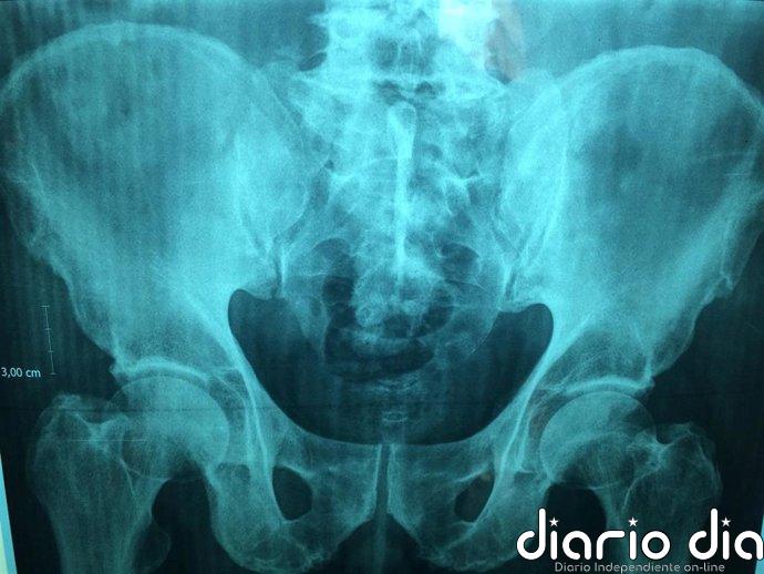 Una IA puede predecir quién sufrirá una fractura de cadera y detectar hasta siete veces más personas en riesgo