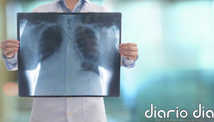 Una nueva prueba podría acelerar drásticamente el diagnóstico de infecciones pulmonares difíciles de detectar